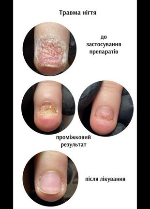 Грибок ногтей, противоогрибковые препараты