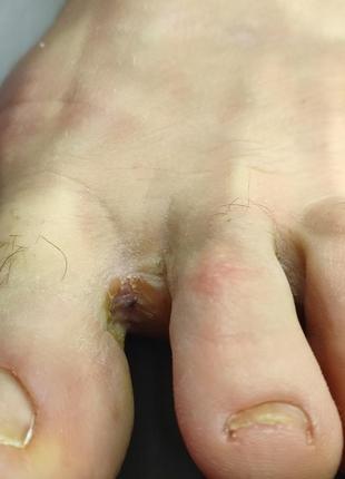 Крем – пенка с клотримазолом и 10%-ной мочевины для ног 35 мл, рedibaehr