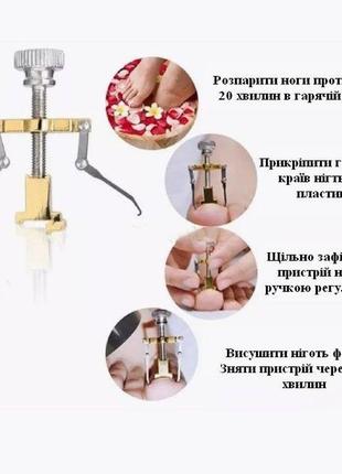 Устройство для коррекции и лечения вросшего ногтя корректор вросшего ногтя,...