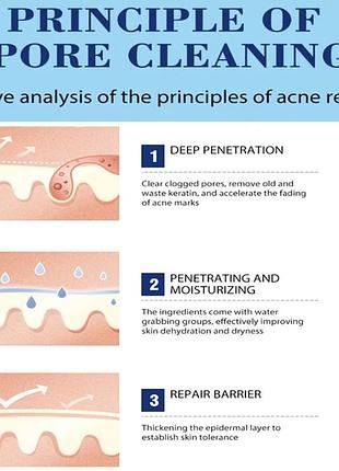 Крем для лечения акне с салициловой кислотой, крем для удаления акне, крем для лица,...