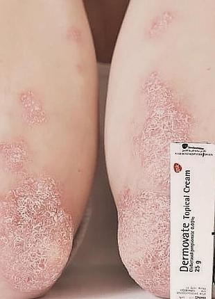 Мазь для венозного расширения вен. египет