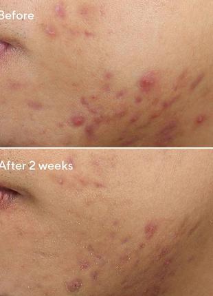 Засіб проти акне із саліциловою кислотою murad — rapid relief acne spot treatment