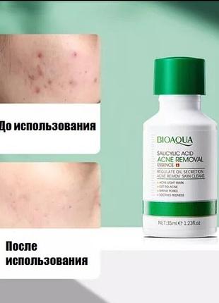 Сыворотка с салициловой кислотой от прыщей и сыпи👆👍😍
