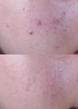 Легкий денний крем- сироватка acne relief maximum strength clearing treatment*2 фото