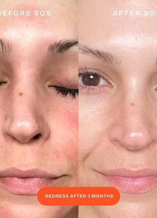 Спрей для проблемной кожи tower 28