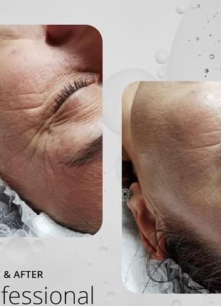 👨‍🔬феруловий пілінг ferulac peel, який "стирає" зморшки