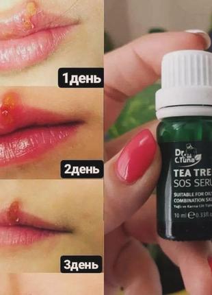 Сироватка sos tea tree при герпесах ,прищах