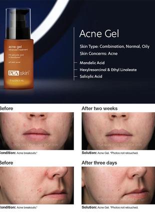 Гель для проблемной кожи против акне pca skin acne gel крем сыворотка 7.3 мл2 фото