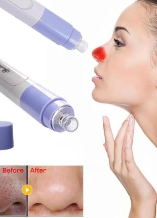 Вакуумний апарат для чистки обличчя очищувач пір pore cleaner1 фото