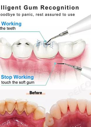 Ультразвуковий скалер, іригатор, видалення зубного нальоту та каменю.8 фото