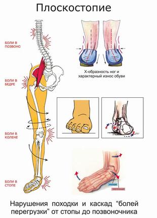 Плоскостопість - плакат