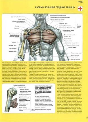 Грудь. разрыв большой грудной мышцы - плакат