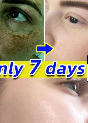 Отбеливающая сыворотка для веснушек fade melasma темные пятна удаление пигментов корректор меланина китайская медицина3 фото