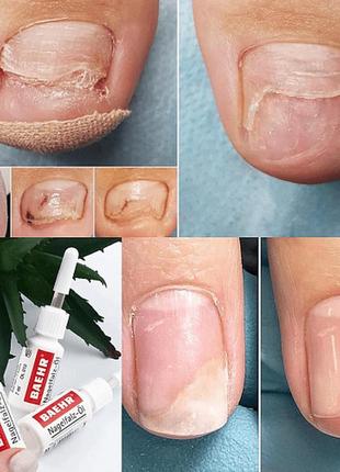 Масло для ногтей и кожи baehr nagelfalz-ol с ростками пшеницы для лечения онихолизиса, оп1 фото