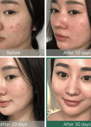 Кислотный очищающий тоник для проблемной кожи some by mi aha-bha-pha 30 days miracle toner