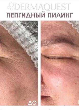 ❤пептидний пілінг з ботокс ефектом dermaquest power peptide resurfacer3 фото