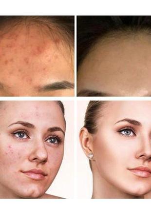 Кислотный кровавый пилинг-сыворотка для лица