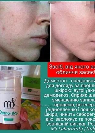 Спеціальний засіб для догляду за «проблемною» шкірою при демодекозі та акне (вугри).2 фото