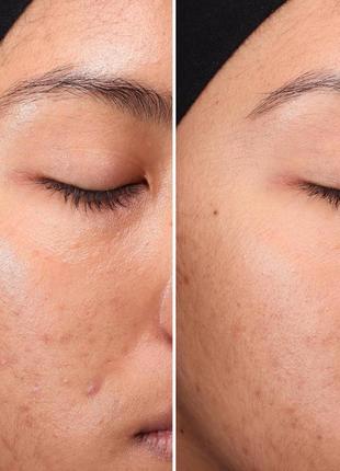 Medik8 press and clear 150ml отшелушивающий тоник с салициловой кислотой