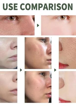 Крем с салициловой кислотой для сужения пор и лечения акне