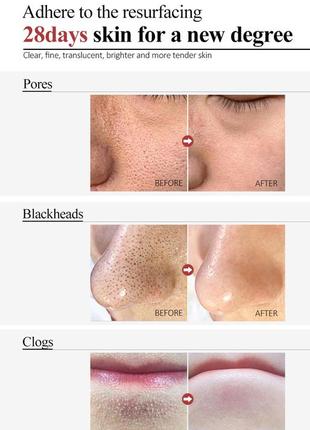 Крем с салициловой кислотой для сужения пор и лечения акне