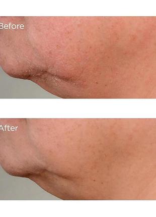 Лифтинг сыворотка для укрепления упругости кожи perricone md