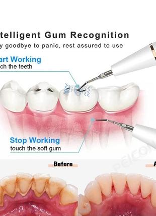 Профессиональный зубной скалер для удаления зубного камня8 фото