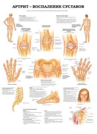 Плакат а3. артрит — запалення суглобів1 фото