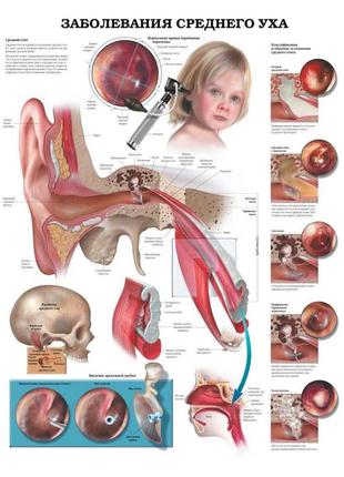 Плакат а3. захворювання середнього вуха