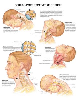 Плакат а3. хлистові травми шиї1 фото