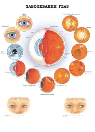 Плакат а3. захворювання очей