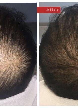 Hairperfect проти випадіння та для відновлення волосся6 фото