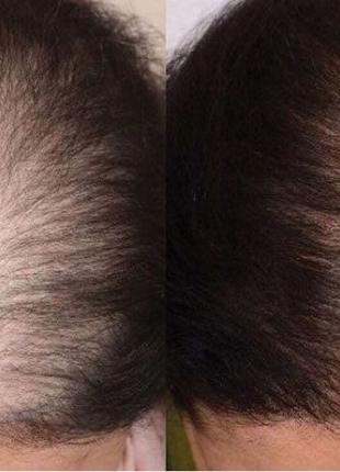 Hairperfect проти випадіння та для відновлення волосся7 фото