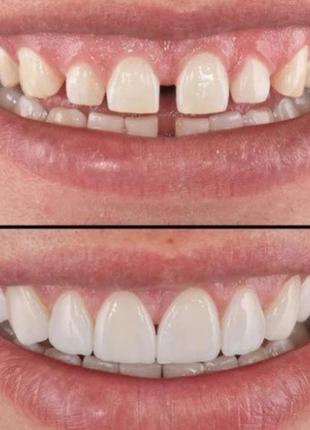 Вініри perfect smile veneers (white) | знімні вініри для зубів4 фото