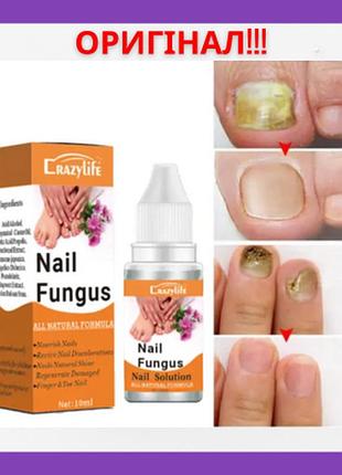 Відновлюючий засіб для лікування грибка нігтів, проти інфекції nail fungus 10ml