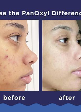 85 г пінка для вмивання від акне, для обличчя та тіла panoxyl acne foaming wash
