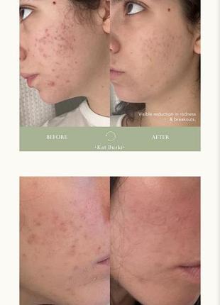 Kat burki vitabiome active skin optimizer спрей для проблемной кожи проблемної шкіри від висипань 2