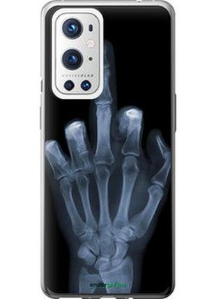 Чохол на oneplus 9 pro рука через рентген "1007u-2250-7673"