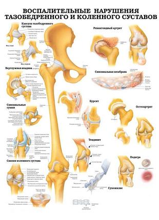 Плакат а3. воспалительные нарушения тазобедренного и коленного суставов ламінація