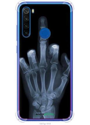 Чохол на xiaomi redmi note 8t рука через рентген "1007sp-1818-7673"