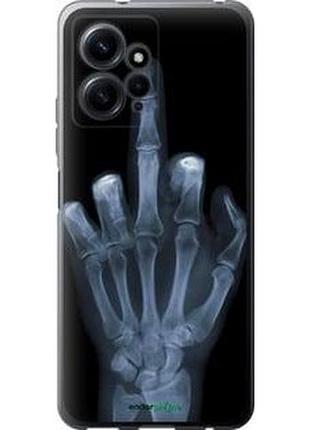 Чохол на xiaomi redmi note 12 4g рука через рентген "1007u-3021-7673"