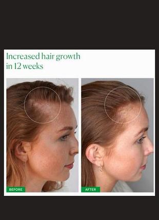 Сироватка для росту волосся 2