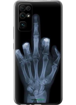 Чехол на huawei honor 30 рука через рентген "1007u-1921-10746"