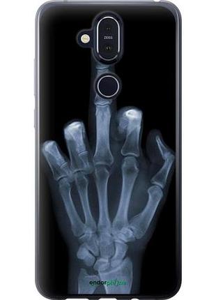 Чехол на nokia 8.1 рука через рентген "1007u-1620-10746"