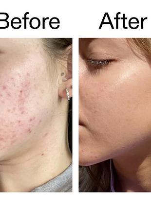 Сыворотка с ниацинамидом the inkey list niacinamide serum