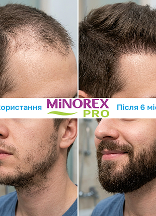 Лосьон миноксидил 5% для стимуляции роста волос 3