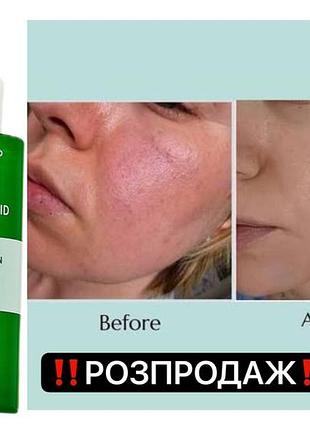 Розпродаж‼️ сироватка для обличчя nine less a-control 10% azelaic acid serum з азелаїновою кислотою 10% акне постакне пігментації почервоніння розацеа
