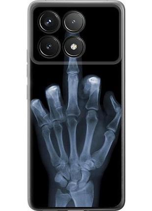 Чехол на xiaomi poco f6 pro рука через рентген из силикона fch_0152589