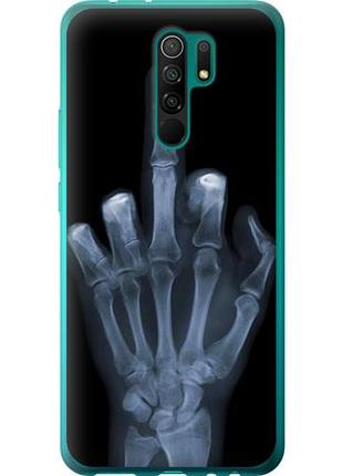 Чехол на xiaomi redmi 9 рука через рентген из силикона fch_0007874