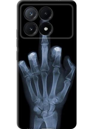 Чехол на xiaomi poco x6 pro рука через рентген из силикона fch_0152577
